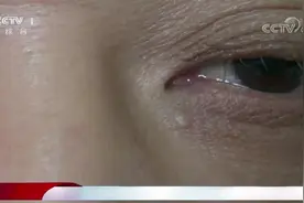 医学上并没有脂肪粒的说法，那眼睛下的小颗粒到底是啥？|生活圈视频封面