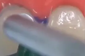 门牙掉了一半原来是这样补的，看着真是太简单，还自然视频封面