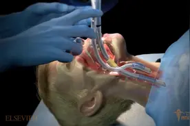 精美的气管插管及各种穿过程!视频封面