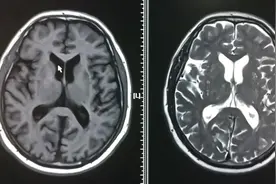 核磁的T1和T2序列如何区分？哪个结构可以快速识别？