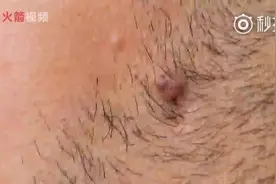 毛发长到肉里会给身体带来多大危害视频封面