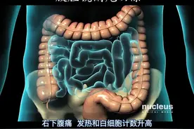 【医学3D动画】腹腔镜阑尾切除的原理及过程视频封面