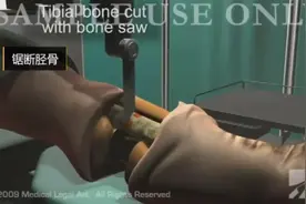 1分钟了解截肢手术全过程视频封面