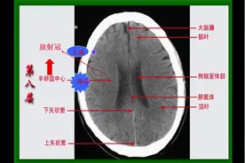 头颅CT解剖（五）：侧脑室体部层面解剖识别，建议收藏视频封面