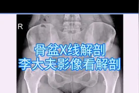 入门级骨盆X线解剖讲解，初学者试用，欢迎收藏视频封面
