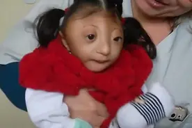 儿科大夫怜爱的看着无脑症宝宝 这么大的先天无脑儿已是奇迹!视频封面