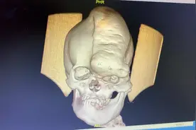 变形综合征(Proteus  syndrome）视频封面