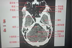 头颅CT解剖（一）：颅底层面识别#湖南医聊超能团#视频封面