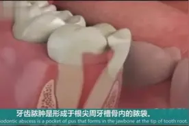 牙龈起脓包，想用消炎药解毒？那么脓包下次还会来！视频封面