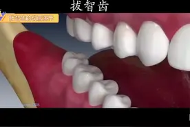 医学3d动画演示-看看拔智齿是怎么操作的？