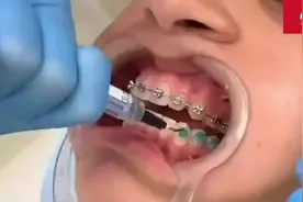 东莞儿童牙齿矫正——真人演示牙套制作过程