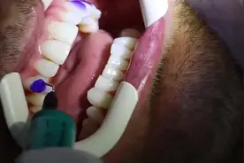 隐适美隐形矫正粘附件过程，通过附件可以让牙齿变化得更快！视频封面