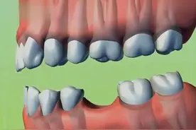牙齿缺失后，会影响邻牙的生长