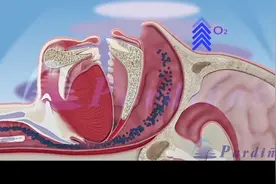 #医学动画#呼吸睡眠暂停综合征动画演示视频封面