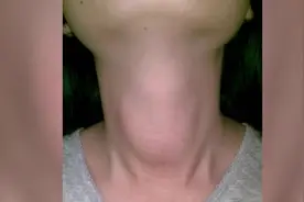 桥本甲状腺炎为什么不能通过公务员体检？#桥本甲状腺炎视频封面