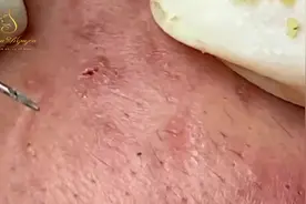 你们喜欢配什么的，音乐还是小说还是原声。#解压视频 #挤黑头视频封面