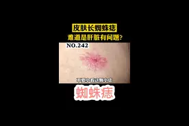 身上长#蜘蛛痣 ，难道是肝脏有问题吗？#皮肤 #医学科普 视频封面