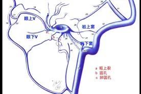 静脉入路栓塞海绵窦区硬脑膜动静脉瘘时，如何开通闭塞的岩下窦？将近两个小时的手术过程剪辑成七分半钟的视频，但开通岩下窦的过程一秒钟都没遗漏 #专业的事交给专业的人视频封面