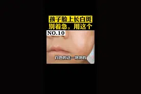 孩子脸上长“虫斑”，这样做才正确！#白斑 #皮肤 #健康视频封面