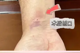 患者出院！西北首例机器人冠脉介入治疗手术成功，创口只有2毫米！#新疆 视频封面
