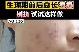每次#生理期 前后就长#痘痘 ，非常苦恼，别烦可以试试这样做#甲硝唑凝胶 #壬二酸 视频封面