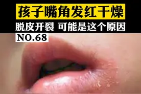 孩子嘴角经常发红干燥、脱皮开裂，可能是这个原因#医学科普 #烂嘴角 #孩子 视频封面