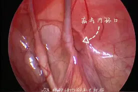 #医学科普 #现场实拍 #原创 疝气腹腔镜微创手术视频独家放送！视频封面
