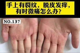  手上脱皮发痒，试试这样子处理。#医学科普 #皮肤 #手脱皮 #指掌角皮症 视频封面
