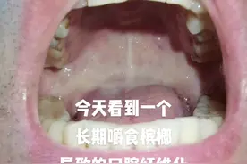 #医生 #医疗  嚼槟榔视频封面