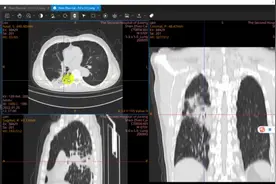 推荐个看片软件，医学影像，DICOM格式，MPR/MIP,PET/CT融合视频封面