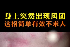 荨麻疹，这个办法简单有效#荨麻疹  #进口西替利嗪  #安全有效#仙特明 视频封面
