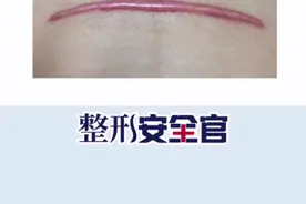 剖腹产瘢痕怎么去除#孕妇 #关爱女性健康 #剖腹产 #整形安全科普 视频封面