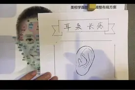 #耳朵长痣 #国庆 #祛痣 评论区的朋友，你们问的问题来了视频封面