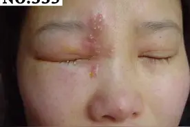 老人眼睛突然疼痛，开始长水疱，当心是“蛇缠腰”发作前兆 #带状疱疹 #医学科普 #老年人 #病毒 视频封面