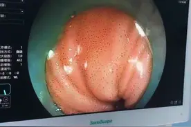 有便秘，吃酵素半年后，肠道竟然变黑了#便秘 #酵素 #健康科普 