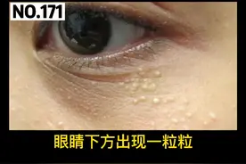 眼周出现硬硬的小丘疹。脂肪粒是什么？#科普 #脂肪粒 #变美 视频封面