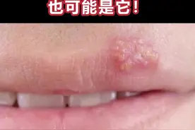 出现了单纯疱疹可不要再亲亲了，避免传染给伴侣。#亲亲 #涨知识 #上火 #嘴巴长泡 视频封面