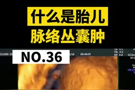 给大家做科普比做手术累多了... 大家咨询太多，没法及时回复请理解。1群，2群已满，需要朋友主页加3群#医学科普 #脉络丛囊肿 