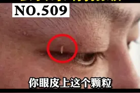 眼皮上长了细细的小肉丝，会传染，千万不要用手去抠#丝状疣 #科普 #健康 视频封面