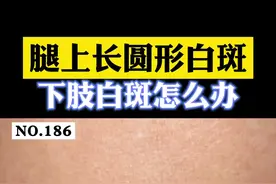#医学科普小腿上长#白斑 ，可能是老年性白斑。#皮肤 #老年斑 视频封面