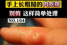 手上长一些粗糙的硬疙瘩，剪了又会长出来，这可能就是#寻常疣 ，别乱剪，可以这样做！#瘊子 #医学科普 视频封面