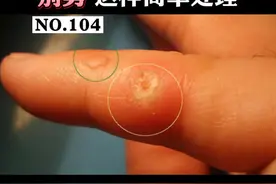 手上长一些粗糙的硬疙瘩，剪了又会长出来，这可能就是#寻常疣 ，别乱剪，可以这样做！#瘊子 #医学科普 视频封面