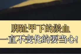 #健康 #科普 脚趾甲的浴血要注意视频封面