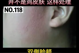 脸颊长一粒粒的小疙瘩，还有点红红的，可能不是鸡皮肤，这种情况处理其实并不难#科普#鸡皮肤 视频封面