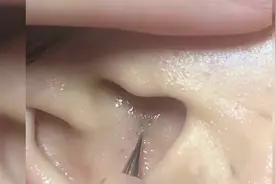 带大家欣赏小哥哥小姐姐是如何挤黑头粉刺的，过程极度舒适解压视频封面