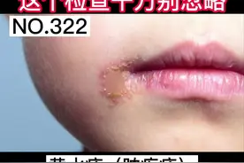 换季时节要注意!小孩嘴巴鼻子周围结黄痂,警惕#脓疱疮 #黄水疮 除了治疗，千万别漏了这个检查！#宝妈 #孩子 视频封面