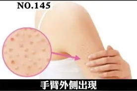 手臂大腿等部位长密集的小疹子，像鸡皮一样，可以试试这样处理#医学科普 #皮肤 #鸡皮肤 视频封面