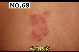 毛虫皮炎，怎么办？#皮肤 #虫咬皮炎