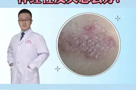 #神经性皮炎 怎么办？试试这样处理#医学科普 #皮肤 视频封面