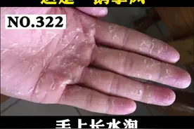 手上长水泡还大面积脱皮，非常痒，这是#鹅掌风！试试这样处理#医学科普 视频封面